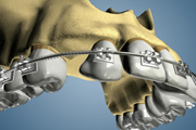Maxillary Lateral Ortho bone Grafting